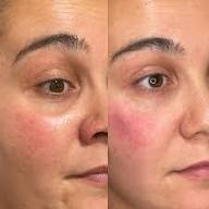 Tear Trough Filler Before and After