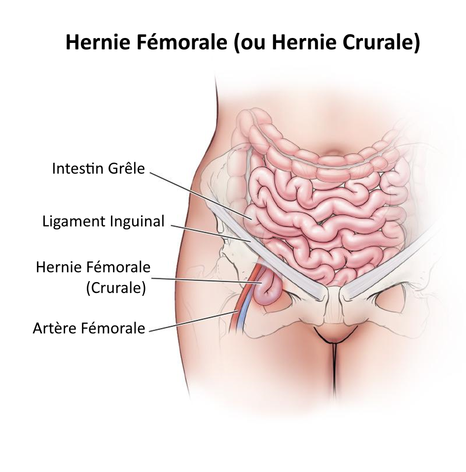 Hernie Fémorale