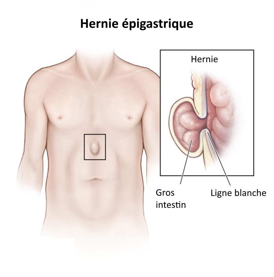 Hernie épigastrique