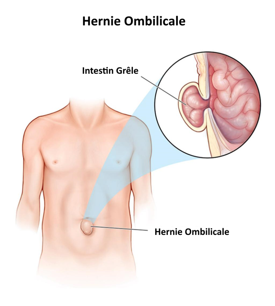 Hernie ombilicale