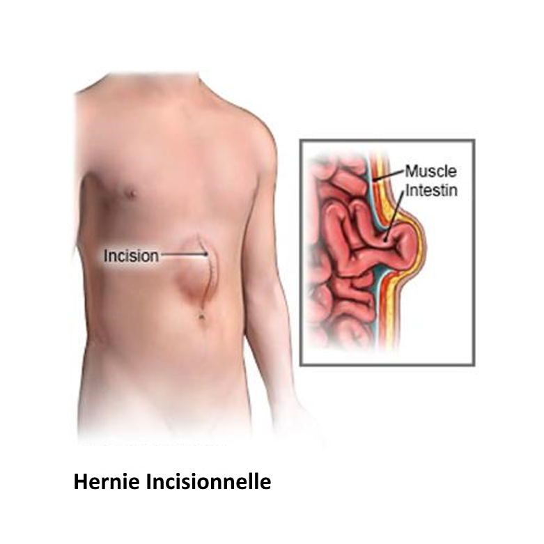 hernie incisionnelle