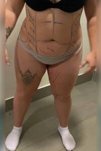 liposuccion