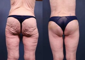 ozempic body